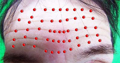 Fold crossings on the forehead
