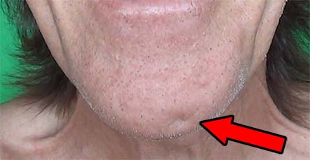 Fold crossing on the chin is a dimple