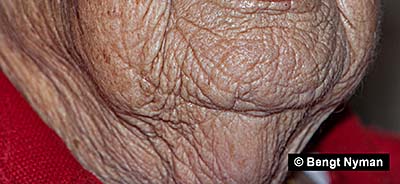 Aged skin