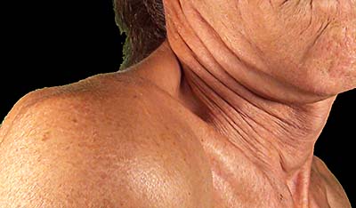 Folds in the neck