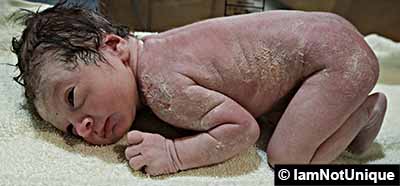 Newborn's skin coated with Vernix caseosa