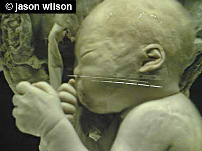 Nine-month-old fetus with horizontal folds on the wrist