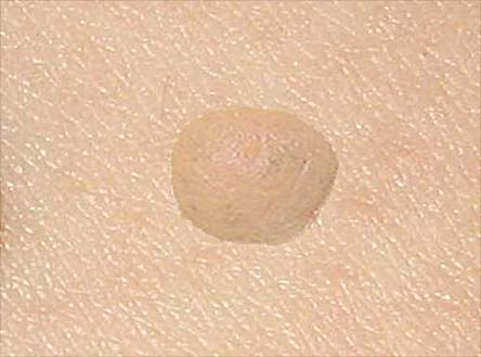 Bump on the skin