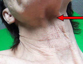 Fold crossing on the neck