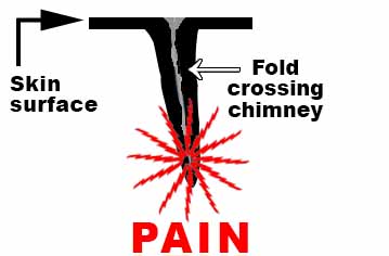 Pain in a fold crossing
