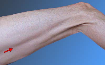 Skin folded into muscle