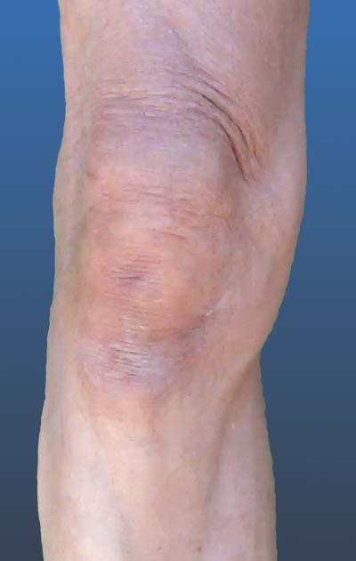 Diagonal folds around the knee