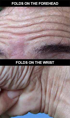 Cutaneous folds on the forehead and on the wrist