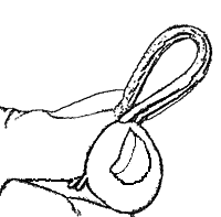 Folded nerves are like folded electrical wires
