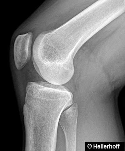 Knee x-ray