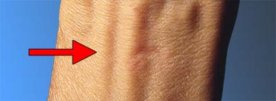 Nail mark after 20 minutes