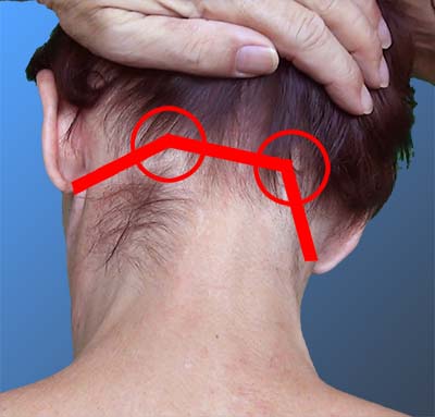 Fold responsible for vertigo