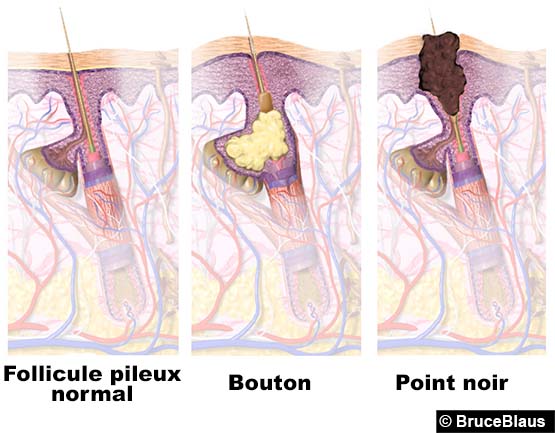 Boutons, points noirs